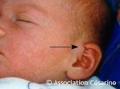 Bébé blessé à l'oreille lors d'une césarienne © Association Césarine
